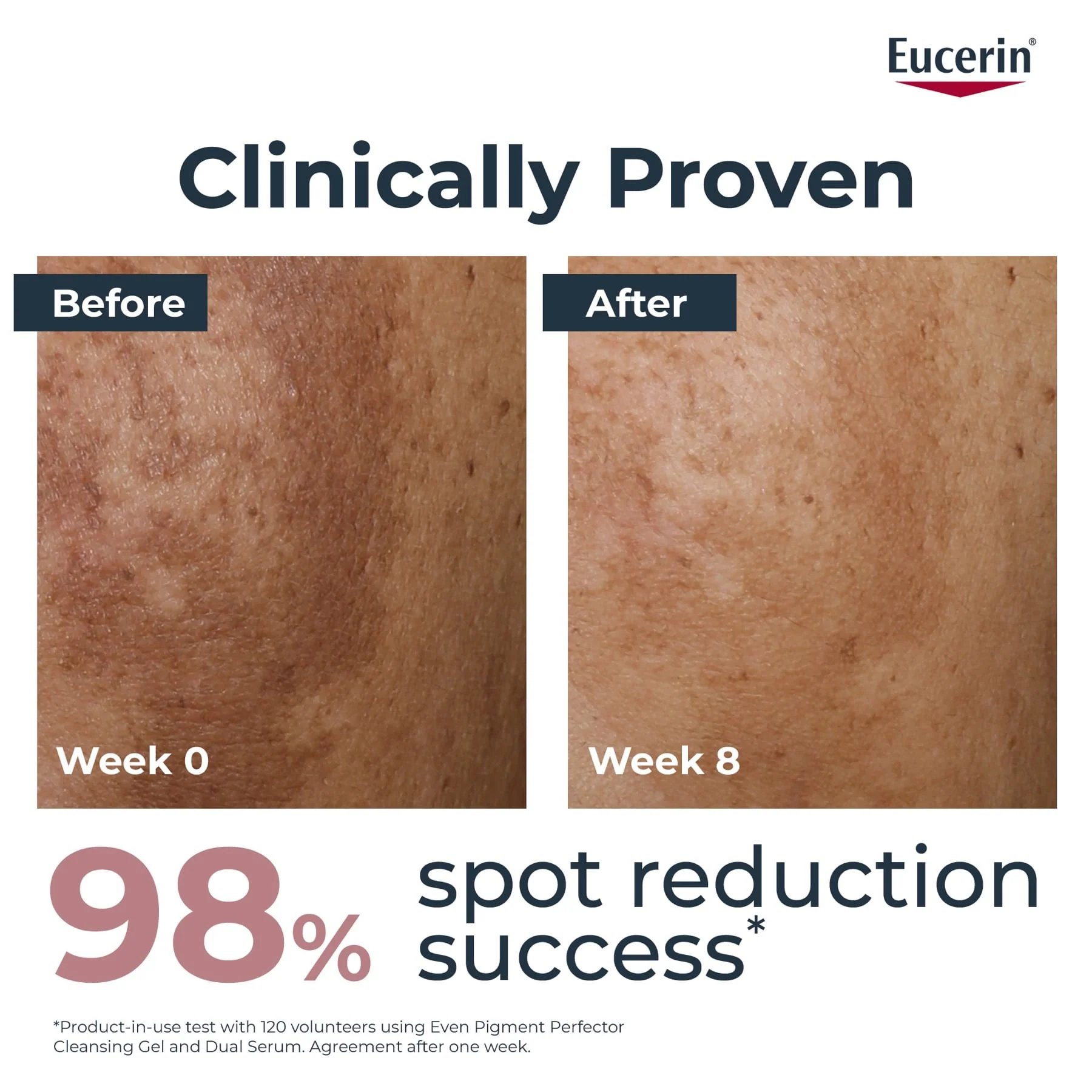 Eucerin Dermopure Clinical Correcting Body Cream for Blemishes & Acne-prone Skin, 200ml - Image 3